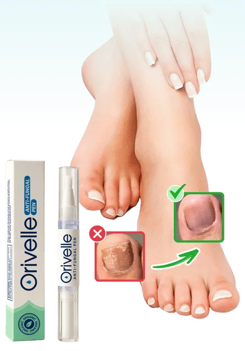 Stylo antifongique Orivelle avec résultats avant/après sur les ongles